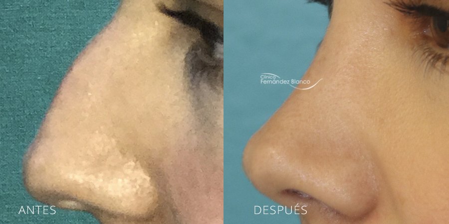 septumplastia, casos reales, rinoplastia madrid, antes y despues, paciente del dr Fernández Blanco, vista de perfil