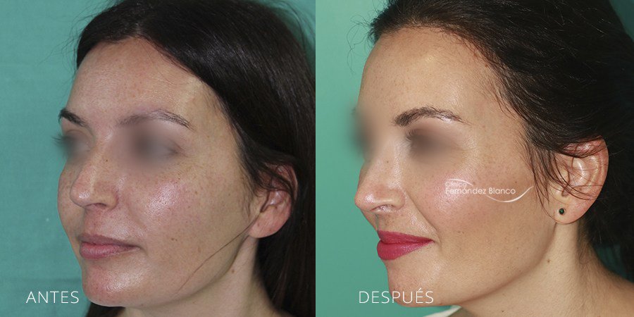rinoplastia fotos antes y despues, operación nariz, casos reales, clínica Fernández Blanco, vista de medio perfil