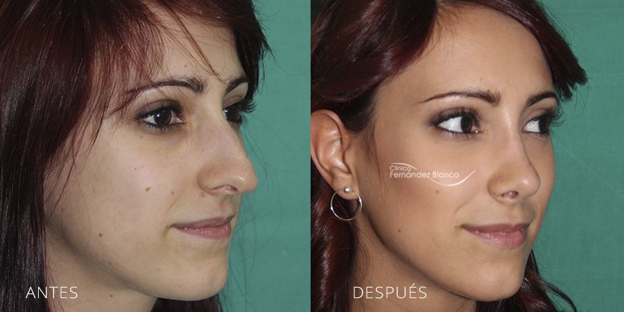 rinoplaste en madrid, operacion de nariz, casos reales, fotos de antes y despues, pacienta del dr Fernández Blanco