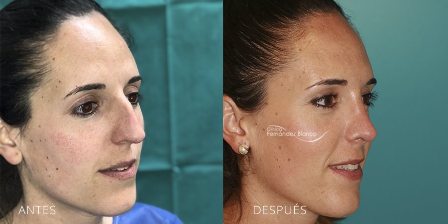 rinoseptoplastia, cirugía de nariz, rinoplastia en madrid, casos reales, paciente del dr Fernández Blanco, vista de medio perfl