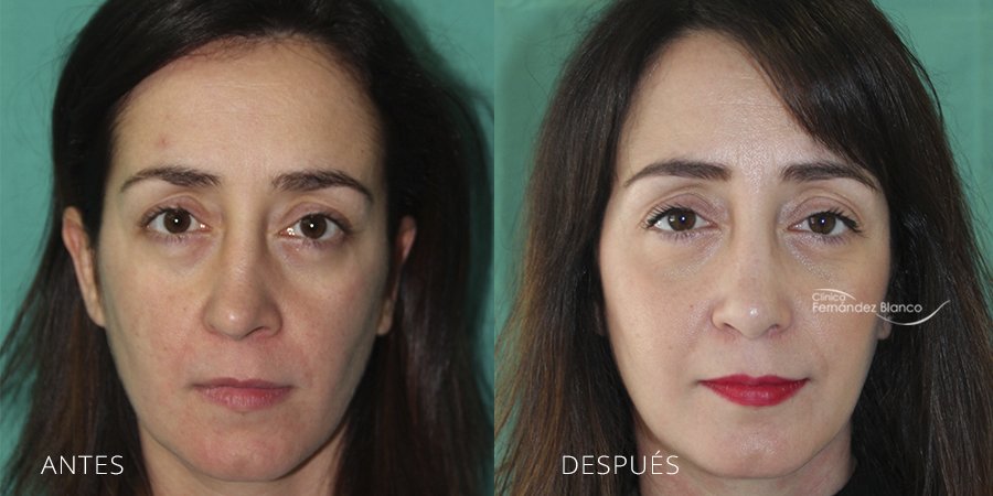 rinoplastia fotos antes y despues, rinoplastia en marbella, casos reales, paciente del cirujano plástico Dr Fernández Blanco