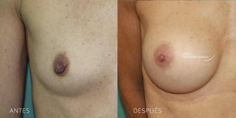Nipple surgery Case 2