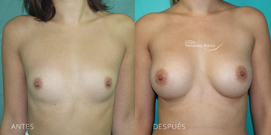 Breast augmentation Case 4