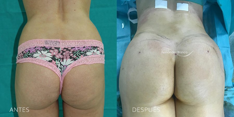 Liposucción de abdomen con injerto de grasa en glúteos realizado en la Clínica Fernández Blanco