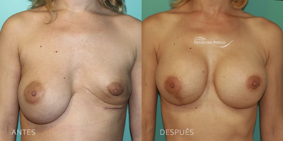 Secondary mammoplasties Case 10
