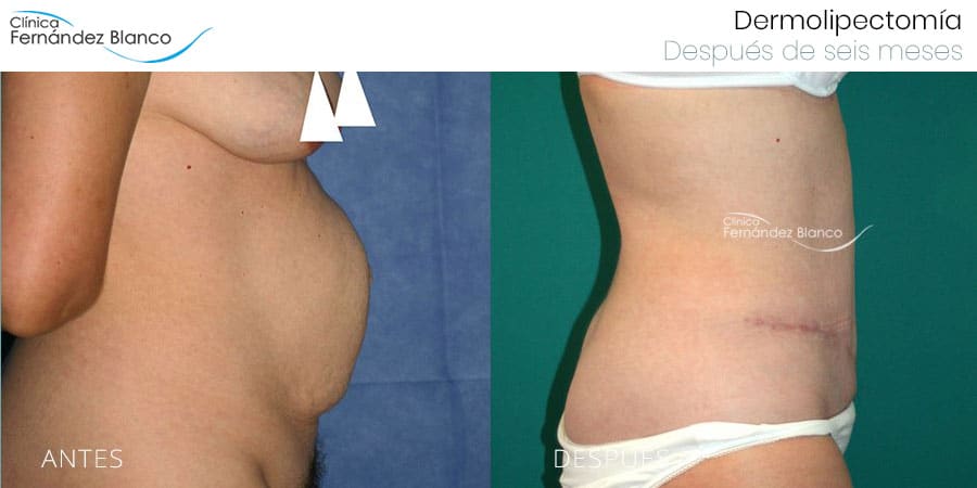 Vista perfil derecho del antes y después de una abdominoplastia España con reparación de rectos y hernia umbilical