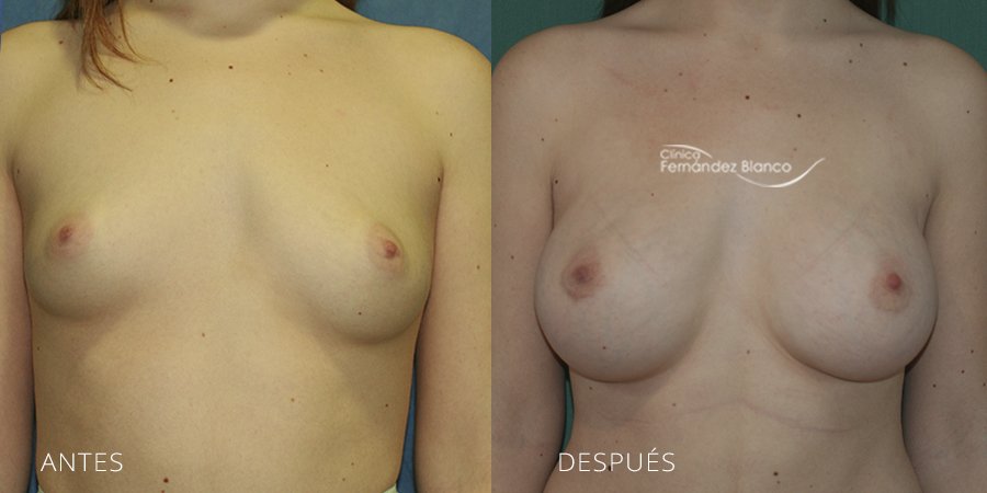 Breast augmentation Case 14