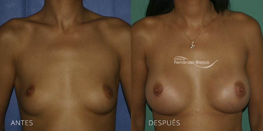 Breast augmentation Case 11