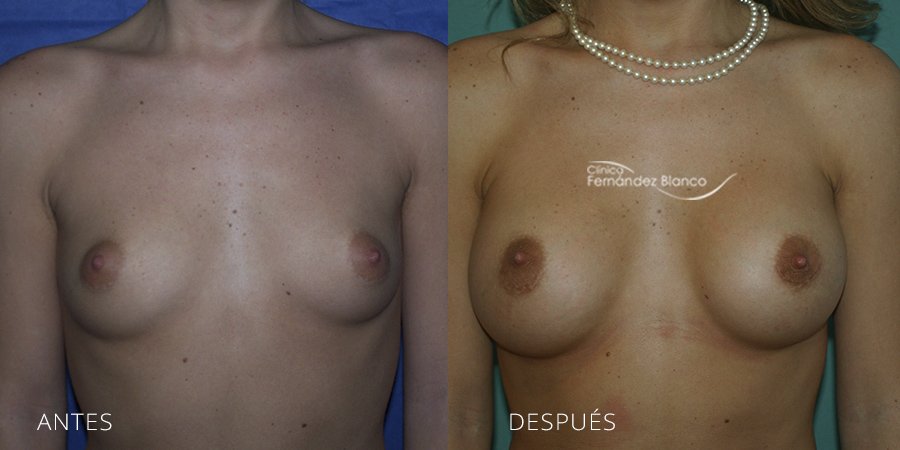 Breast augmentation Case 13