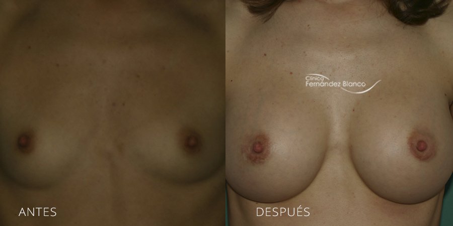 Breast augmentation Case 21