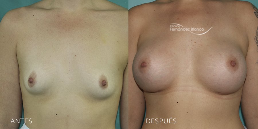 Breast augmentation Case 5