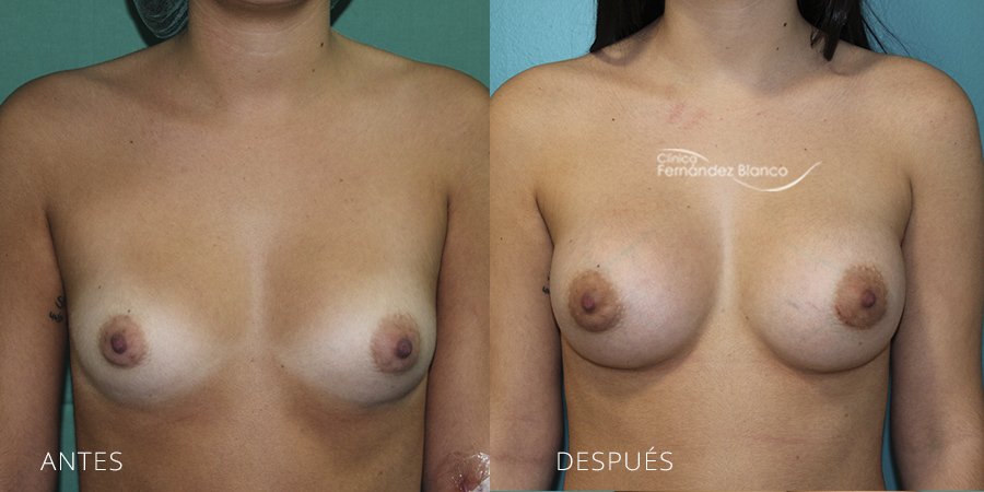 Breast augmentation Case 40