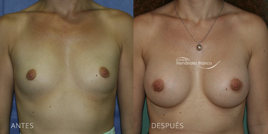Breast augmentation Case 19