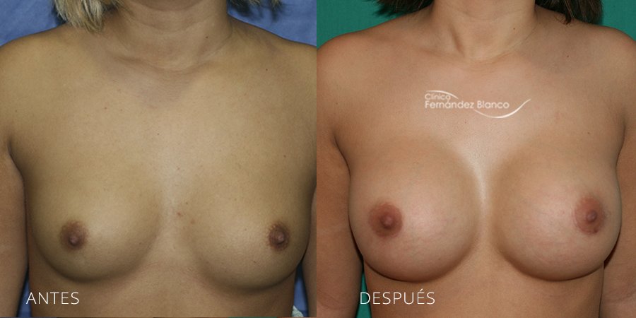 Breast augmentation Case 10