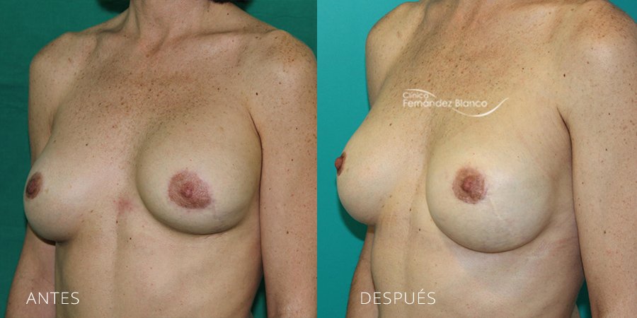 Secondary mammoplasties Case 11