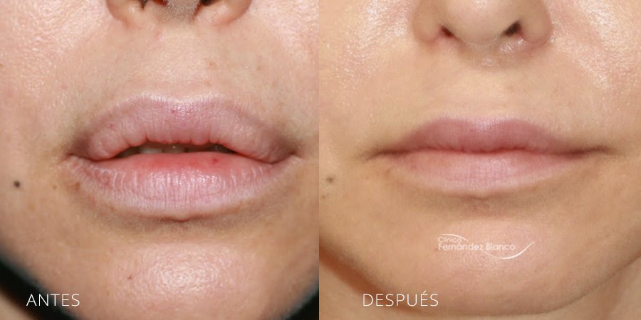 Lip augmentation Case 4