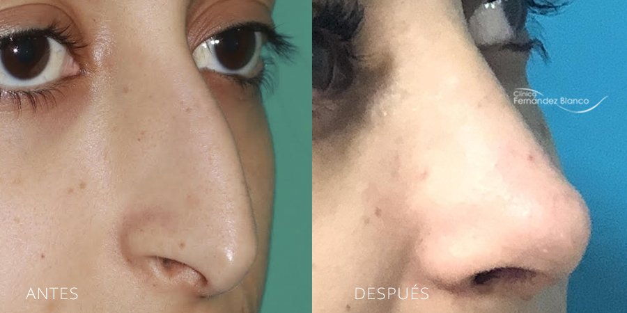 rinoplastia antes y despues, cirugía de nariz, casos reales, clinica Fernández Blanco en Madrid, vista de medio perfil