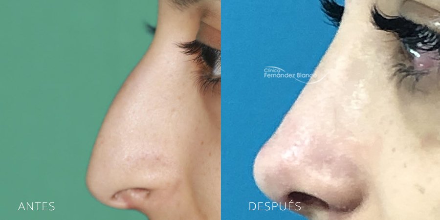 rinoplastia antes y despues, cirugía de nariz, casos reales, clinica Fernández Blanco en Madrid, vista de perfil