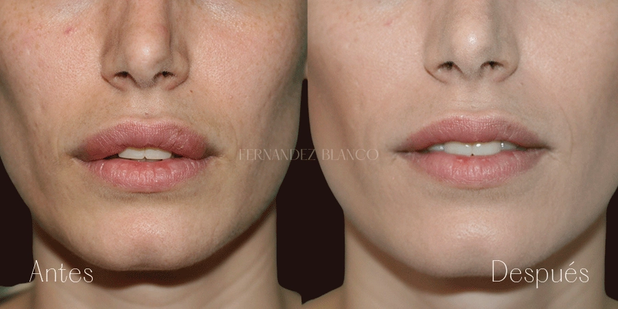 Cirugía estética queiloplastia labios