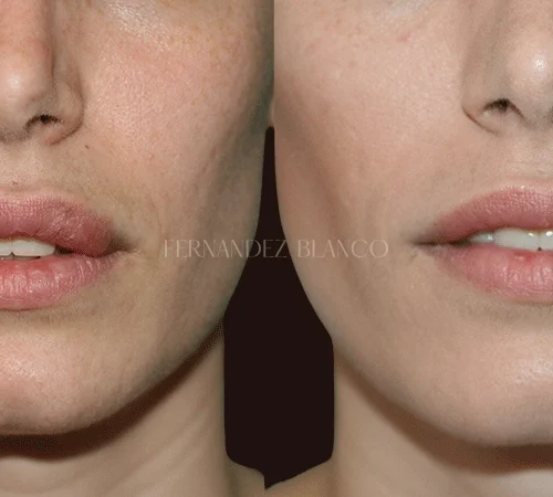 Cosmetic surgery cheiloplasty lips