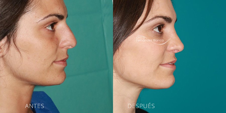 operación nariz, rinoplastia en marbella, fotos de antes y despues, casos reales, clinica Fernández Blanco, vista de perfil