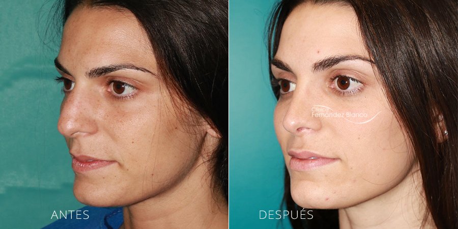 operación nariz, rinoplastia en madrid, fotos de antes y despues, casos reales, clinica Fernández Blanco, vista de medio perfil