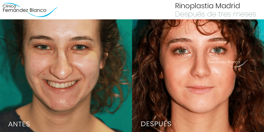 Foto real de una operación punta nariz antes y después