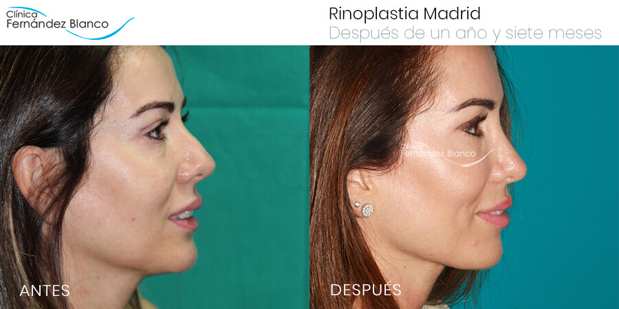 Antes y después de una rinoplastia punta nariz