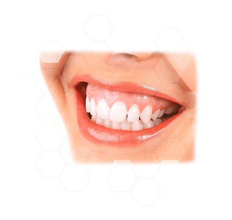 corrección de la Sonrisa Gingival con botox, bloquear los músculos que elevan el labio madrid