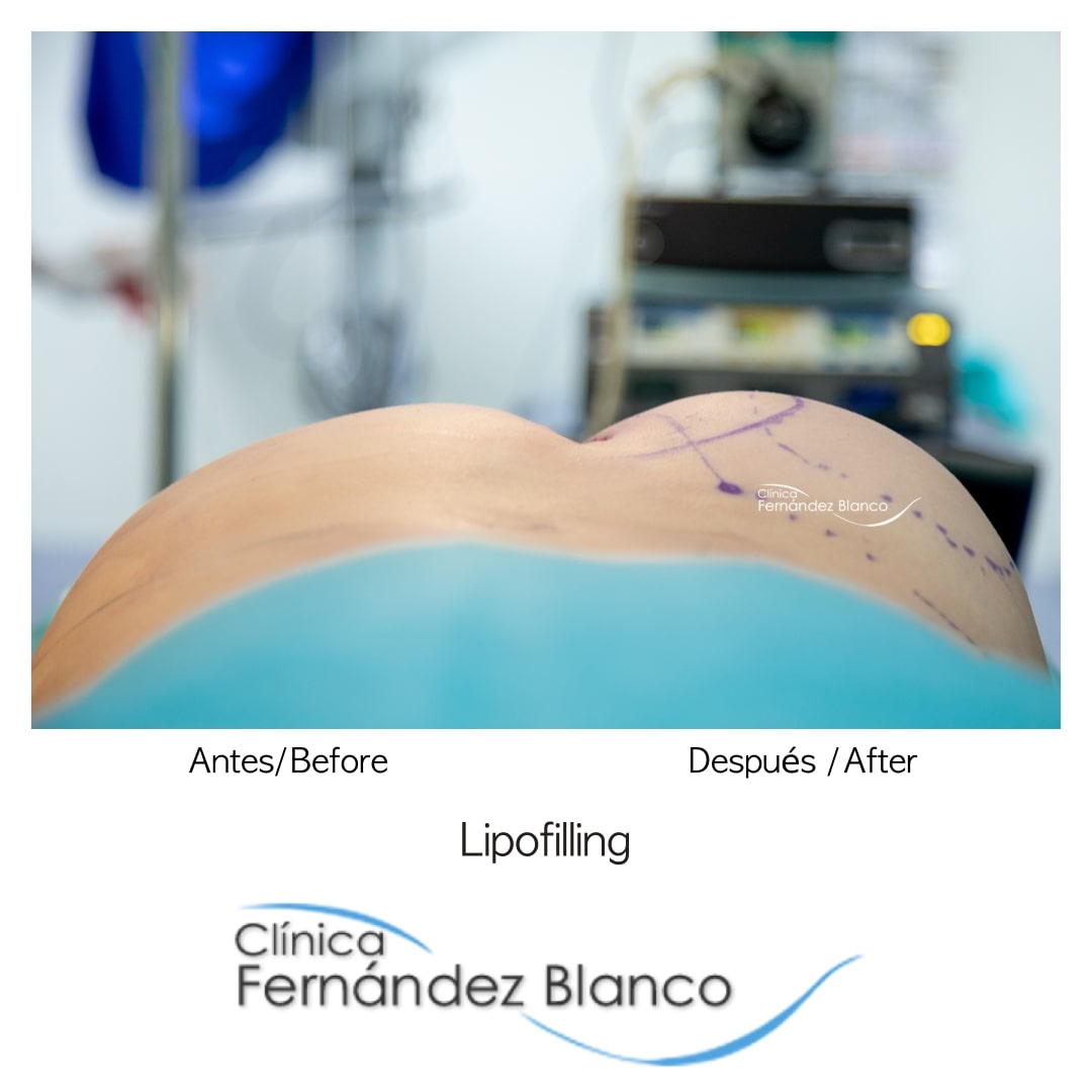 Lipofilling en Madrid, antes y después del injerto de grasa, lipofiling glúteos, operación en clínica Fernández Blanco