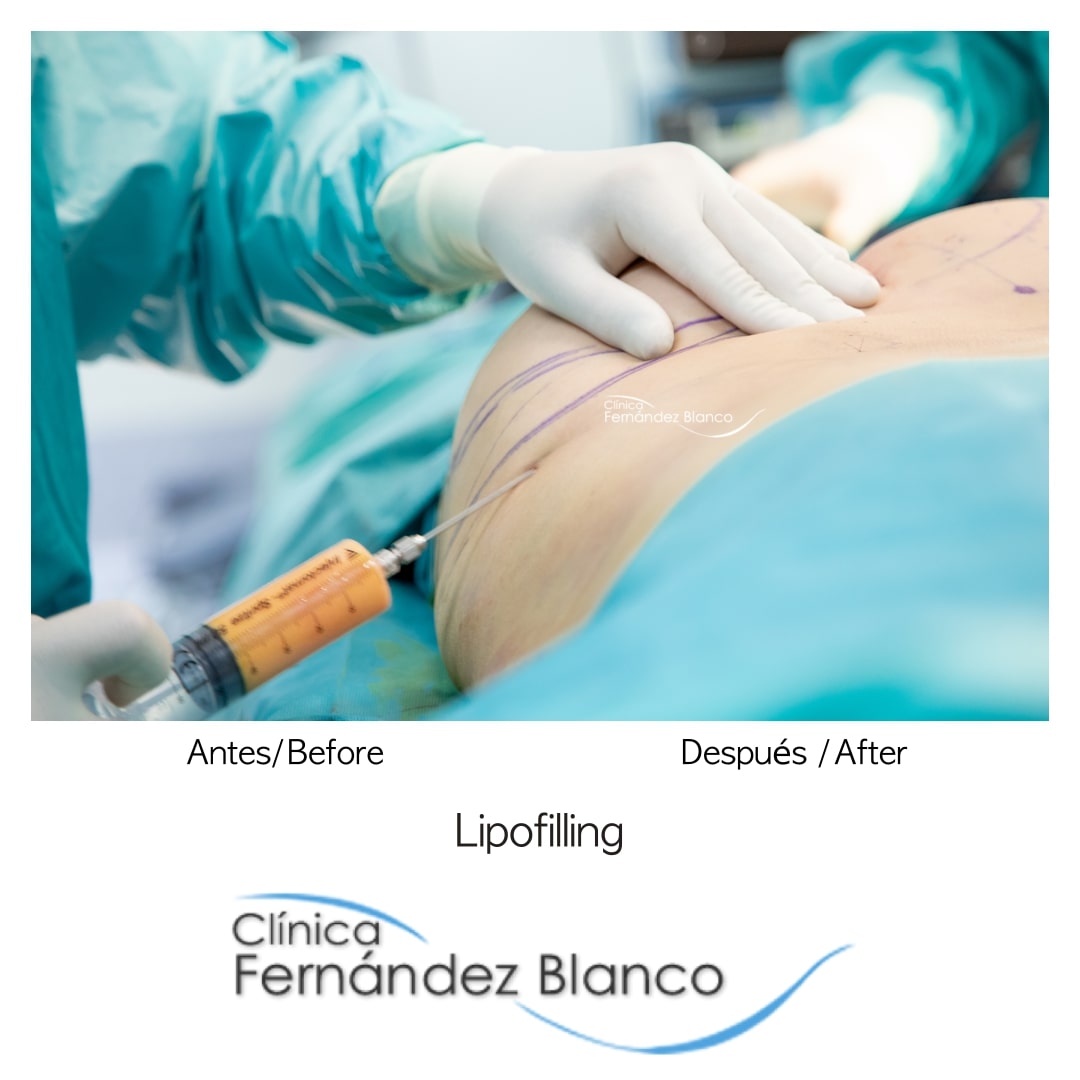 Lipofilling en Madrid, injerto y que la grasa en la zona a tratar, operación en clínica Fernández Blanco