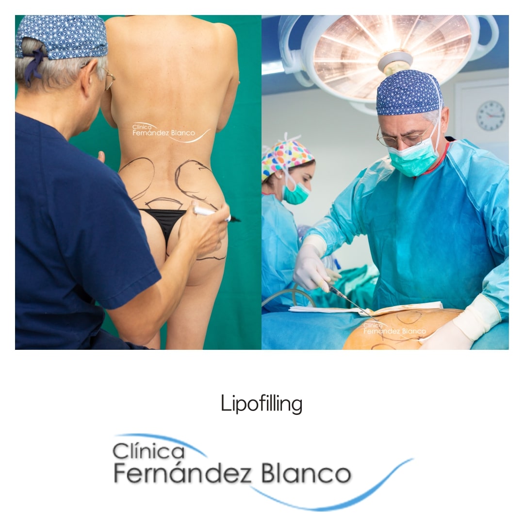 Lipofilling en Madrid, obtención de la grasa del paciente por medio de liposucción, operación en clínica Fernández Blanco