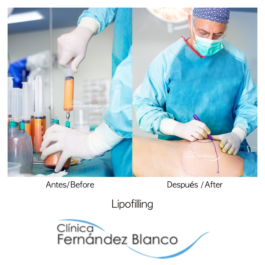 Lipofilling en Madrid, preparación del injerto de grasa, operación en clínica Fernández Blanco