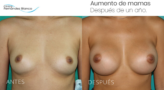 Vista frontal del antes y después de un aumento de pecho realizado por el equipo de cirujanos de la Clínica Fernández Blanco.