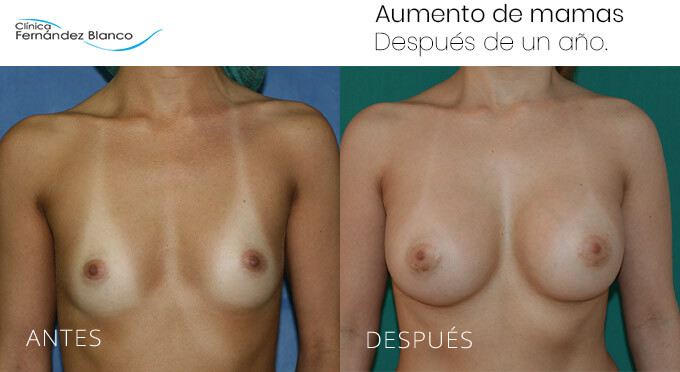 Vista frontal de una mamoplastia Málaga (para corregir asimetría), realizada en la Clínica FB
