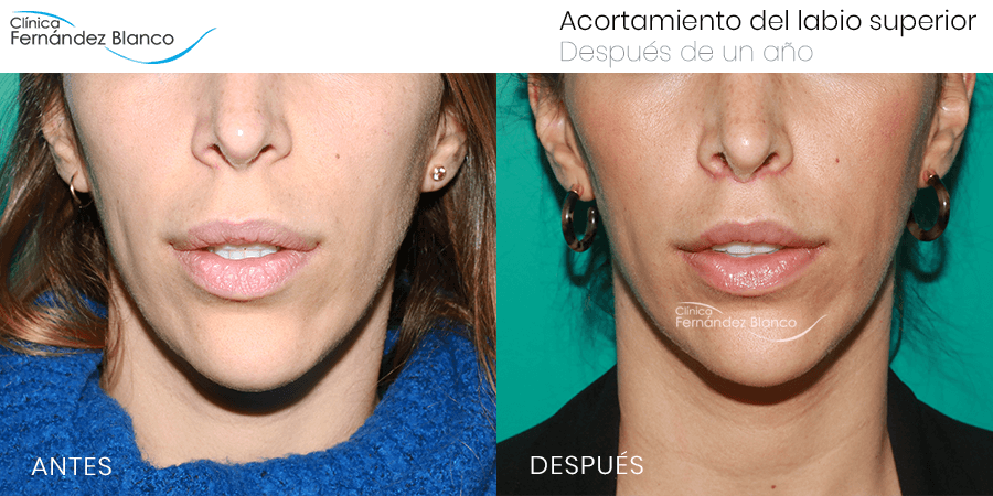 Antes y después acortamiento de labio superior realizado en la Clínica Fernández Blanco