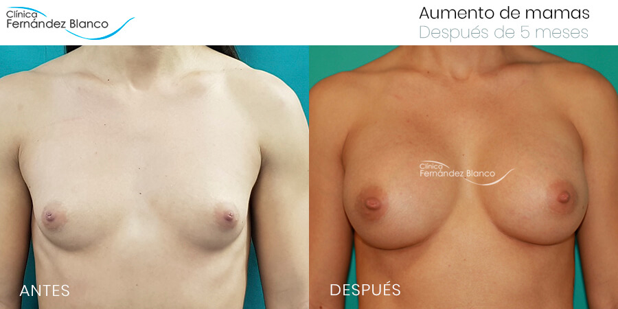 Aumento de mamas caso 50, fotos de antes y después, paciente del dr Fernández Blanco, 5 meses de evolución, vista de frente