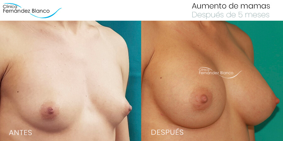 Aumento de mamas caso 50, fotos de antes y después, paciente del dr Fernández Blanco, 5 meses de evolución
