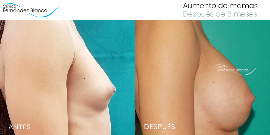 Aumento de mamas caso 50, fotos de antes y después, paciente del dr Fernández Blanco, 5 meses de evolución, vista de lado