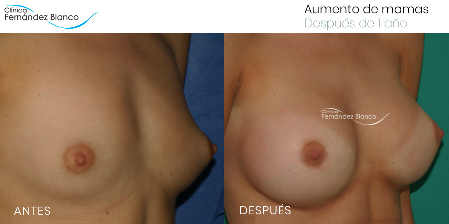 Aumento de mamas, fotos de antes y después, caso 22, paciente del dr Fernández Blanco