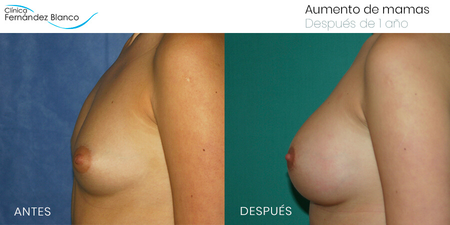 Aumento de mamas, fotos de antes y después, caso 22, paciente del dr Fernández Blanco, vista de lado