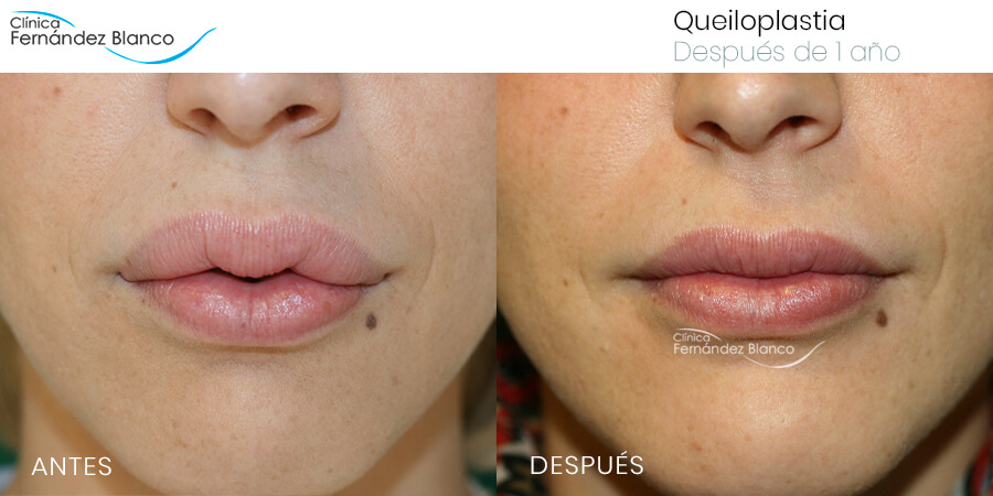 Antes y después de una paciente con una queiloplastia para extraer biopolímeros en labios (Vista frontal)
