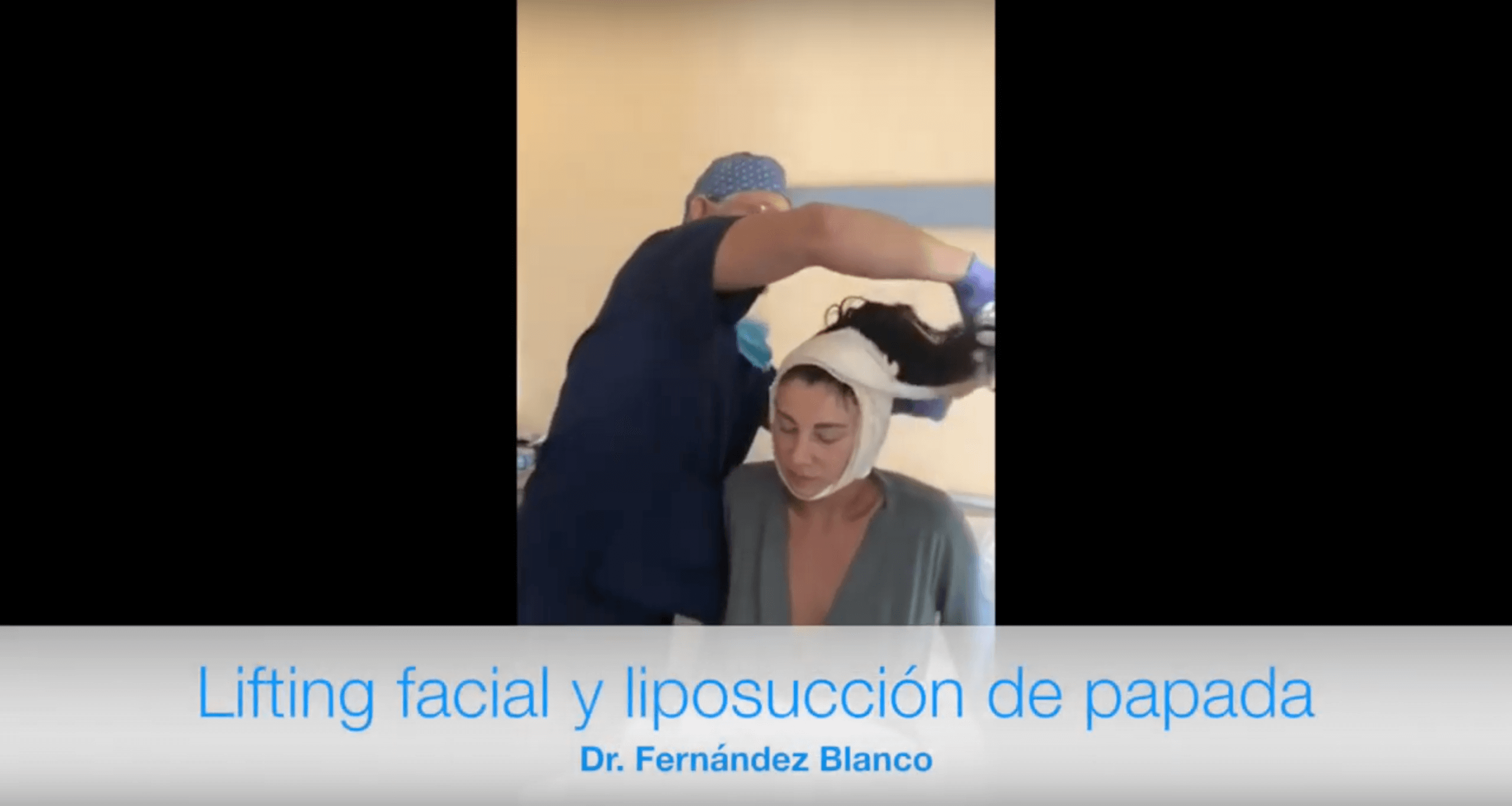 Video de cómo luce una paciente luego de una cirugía de lifting facial y liposucción de papada