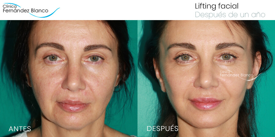 mini lifting facial antes y después Cele mai bune rezultate pentru îngrijirea pielii anti-îmbătrânire