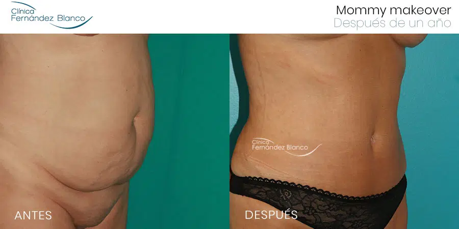 Antes y después de abdominoplastia en mommy makeover realizado en la Clínica FB