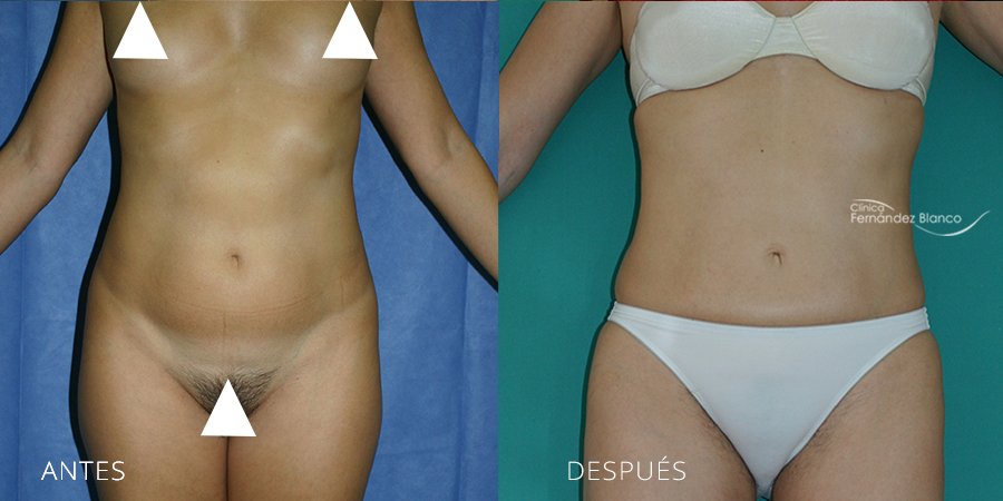 Antes y después de liposuccion de cintura en mommy makeover realizado en la Clínica FB