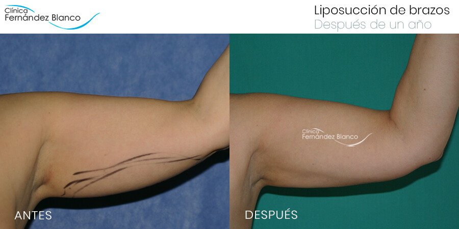 Obstinado bomba preocuparse ▷ Liposucción de brazos | Caso 1 | Antes y después | Cirugía