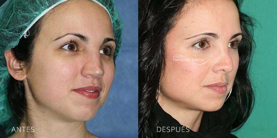 Problems of a poorly operated nose