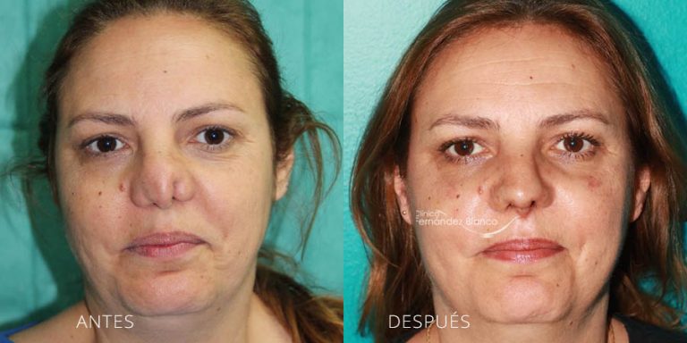 Antes y después de una rinoplastia secundaria | Caso de nariz operadas con malos resultados