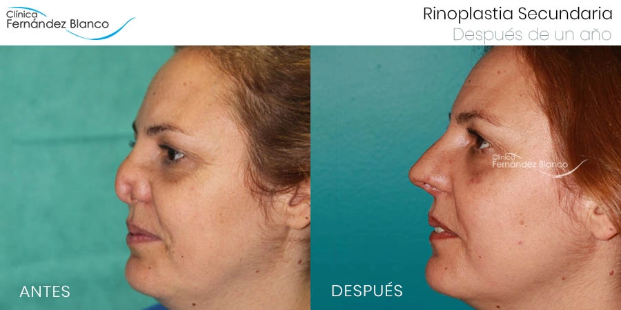 Poorly operated nose before and after
